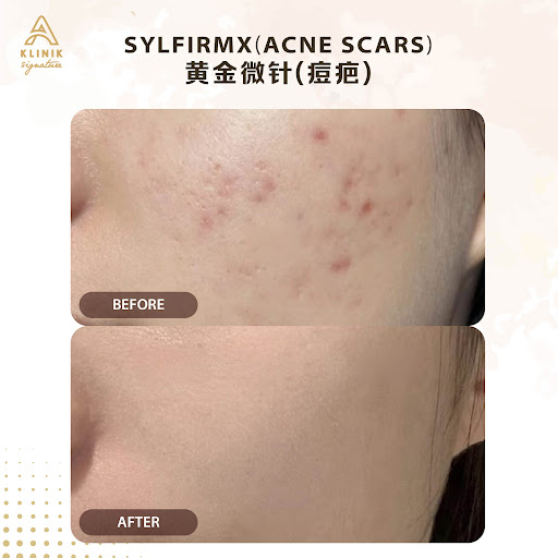 A Klinik Signature Damansara Aesthetic Clinic 医美诊所 Ultherapy 美版超声刀 | Sculptra 童颜针 | Acne & Acne Scar 痘痘 痘疤 | Hair Growth 生发